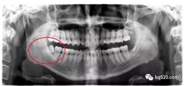 广东省口腔医院智齿拔除经验分享