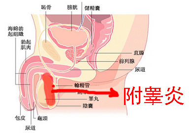 附睾炎两个月，经历、治疗与预防